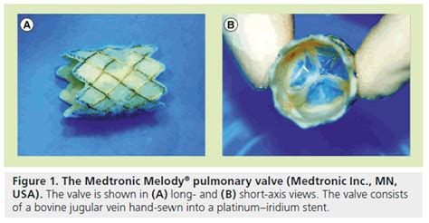 Percutaneous Pulmonary Valve Implantation
