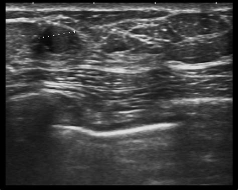 Ultrasound Of Fluid Level Is Seen In Cystic Lesion Which Is