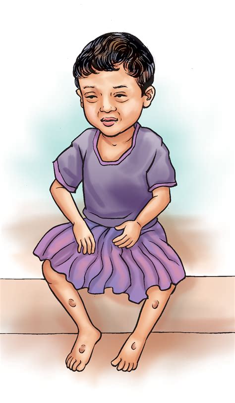 Sick Child Health Malnourished Toddler 02 Nepal Iycf Image Bank