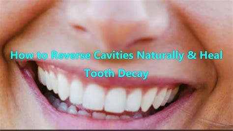 Is it possible to reverse tooth decay by brushing, or eating certain foods? How to Reverse Cavities Naturally & Heal Tooth Decay - YouTube