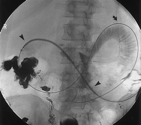 Gastroduodenal Stent Placement Current Status Radiographics