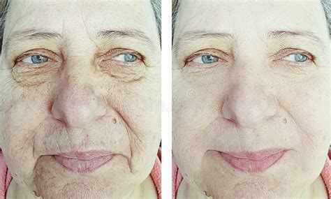 Face Wrinkles Elderly Woman Before And After Rejuvenation Treatment