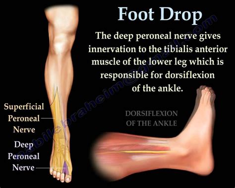 Foot Drop Peroneal Nerve Injury Everything You Need To Know Dr