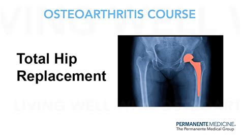 Hip Osteoarthritis Class Roseville Orthopedics