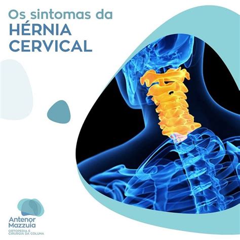 Os sintomas da hérnia cervical Antenor Mazzuia Ortopedia e Cirurgia