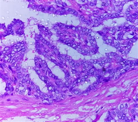 Thyroid Cancer Microscopic Image Of Metastatic Papillary Carcinoma Of