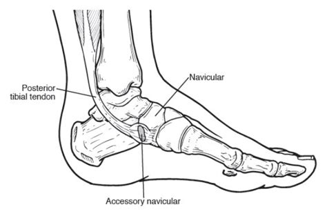 Accessory Navicular Syndrome Ankle Foot And Orthotic Centre