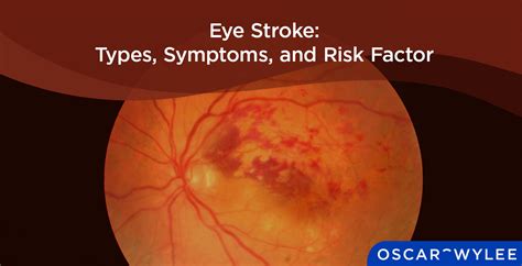 Eye Stroke Types Symptoms And Risk Factors