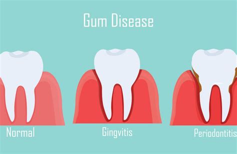 The Causes Of Gum Disease Mark R Turner Dds