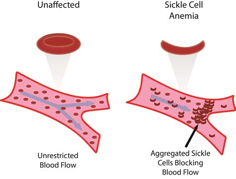 Sickle Cell Disease Sickle Cell Anemia Stepwards