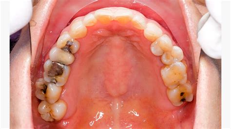 Teeth Filling In Dubai Composite Dental Fillings 2023