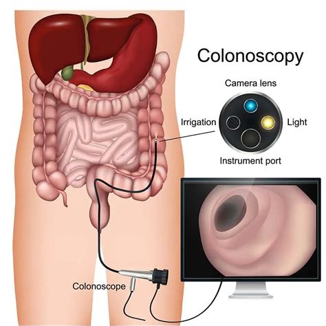 Colon Cancer Stages Symptoms Causes And Screening