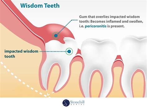 Impacted Wisdom Teeth Stonehill Dental Hamilton Dentist