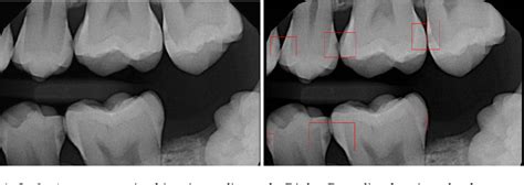 Figure 1 From Detection Of Tooth Caries In Bitewing Radiographs Using