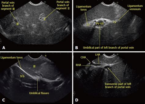 Liver Lobes Ultrasound