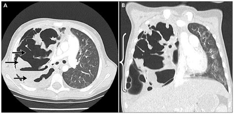 Diagnostic Imaging Of Lung Abscess Lung Abscess And Necrotizing