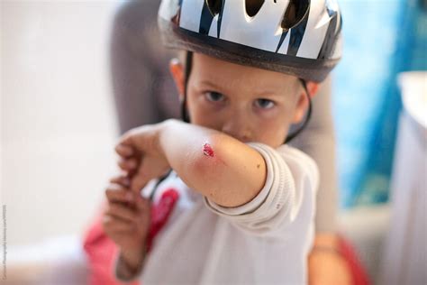 Boy Shows Off His Scraped Elbow Del Colaborador De Stocksy Carleton