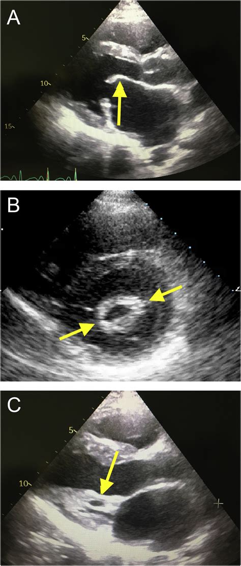 Advances In Rheumatic Mitral Stenosis Echocardiographic