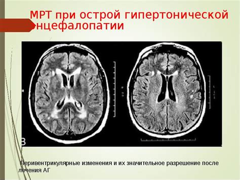 Энцефалопатией называется группа дизонтогенетических заболеваний головного мозга невоспалительного характера. Гипертоническая энцефалопатия - презентация, доклад ...