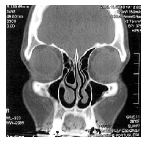 Case 2 Preoperative Ct Evidencing The Septal Deviation And Ogival