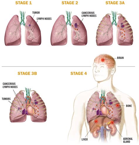 Stage 4 is an advanced stage of lung cancer, where the tumor has spread to nearby organs as well as distant organs and tissues. Medical Illustration: Non-Small Cell Lung Cancer