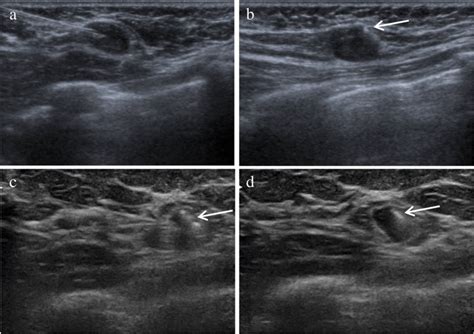 Axillary Ultrasound Images Of A Patient With A Proven Tumor Positive