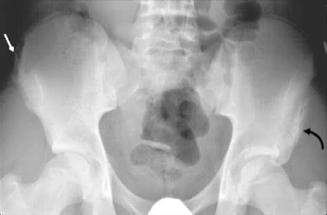 Avulsion Fracture Hip Iliac Crest