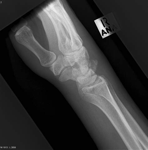 Triquetral And Radial Styloid Fracture Image