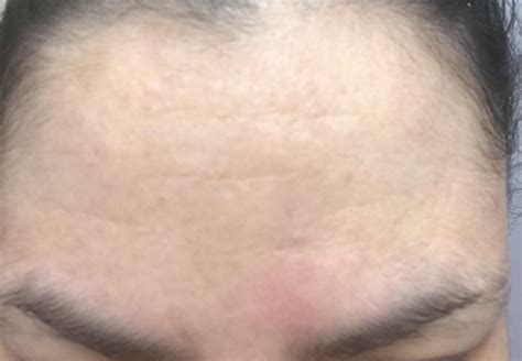 Skin Concerns Small Bumps On Forehead That Are Skin Coloured And