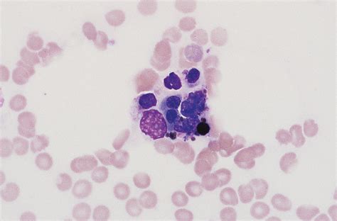 A Hemophagocytic Histiocyte Containing Erythroid Cells And Granulocytes