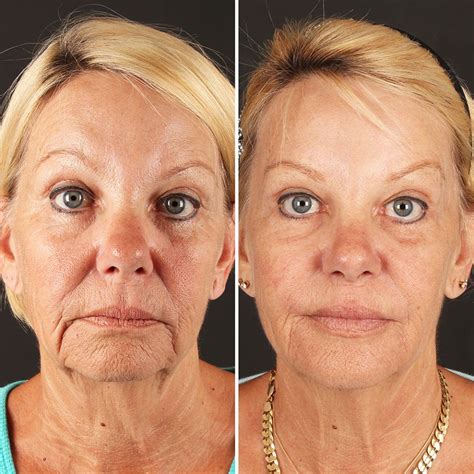 Microneedling Before And After Marionette Lines Before And After