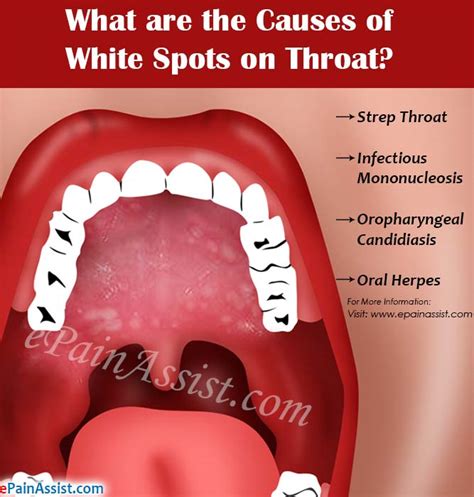 What Are The Causes Of White Spots On Throat