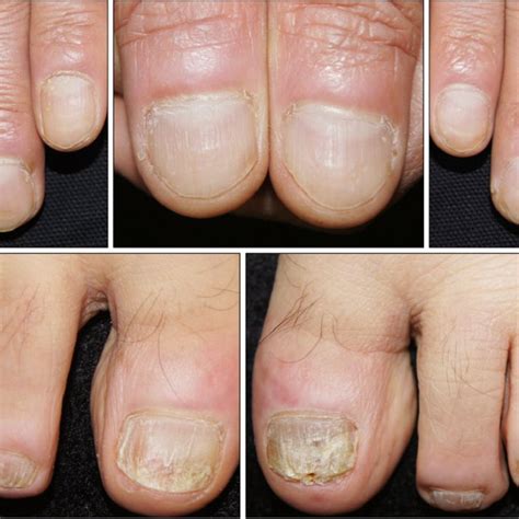 Improvement In Nail Psoriasis After The Fourth Injection Of