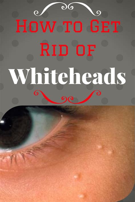 How To Get Rid Of Whiteheads By Whiteheads Better