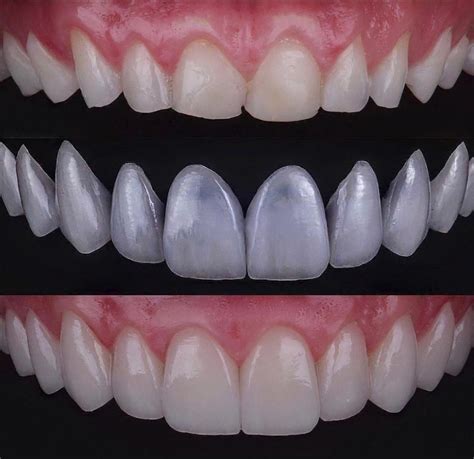 Emax Veneers In Turkey Can Be Completed In 5 Days