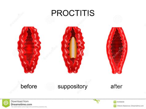 Before And After Treatment Of Rectal Suppositories Stock 59 Off