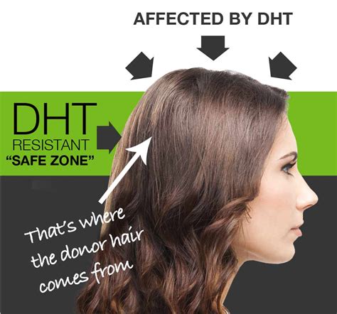 Dht is especially linked with the most common cause of hair loss observed in men: Female Hair Loss: It Can Be Corrected!