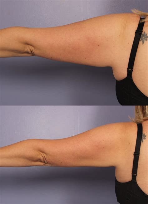 I Got Coolsculpting And Here S What Happened Before And After Photos