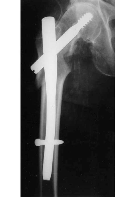 Ap View Of A Trochanteric Fracture Treated With A Gamma Nail
