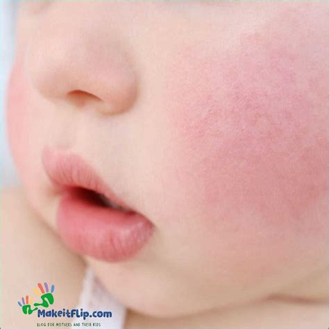 Red Cheeks Baby Causes Treatment And Prevention Updated March 2024