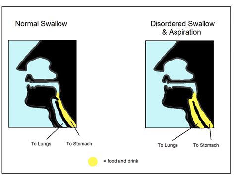 Swallowing Difficulties In Dementia Hull University Teaching Hospitals Nhs Trust
