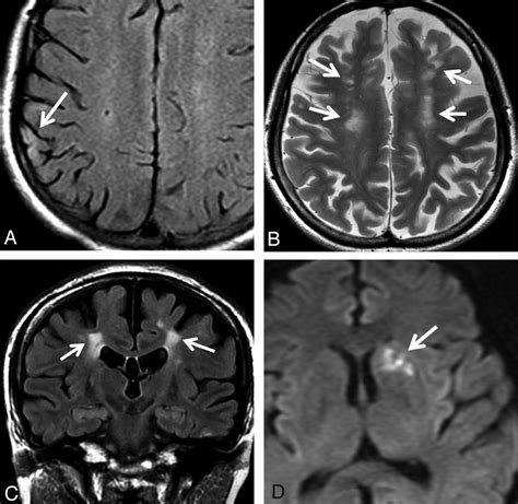 Brain Mr Findings In Patients With Systemic Lupus Erythematosus With
