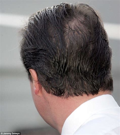 Bald Spots On Head Pictures Driverlayer Search Engine