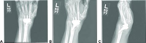 A Anteroposterior B Oblique And C Lateral Views Of Arthroplasty