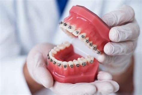 Dental Braces In Turkey Cost Procedure And Treatment Abroad