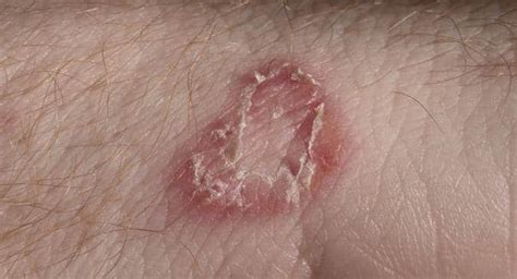 Dos And Donts To Treat Fungal Skin Infections