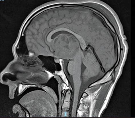 Glioblastoma Mri Revealed A Solid Cystic Lesion In The Topography Of