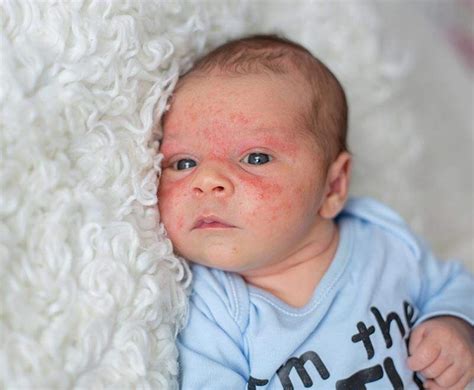 Mottled Skin And Skin Colour Changes In Babies Baby Skincare Emmas Diary