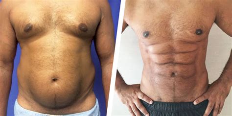 This Plastic Surgery Procedure Gives You Six Pack Abs