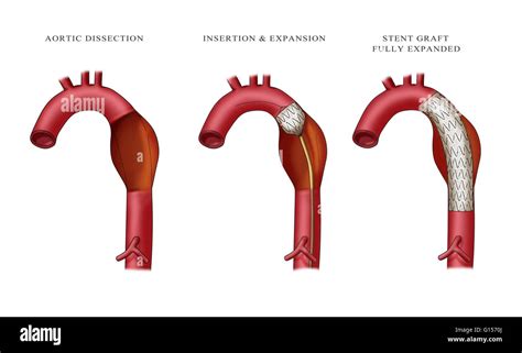Illustration Depicting Insertion Of An Aortic Aneurysm Stent Far Left